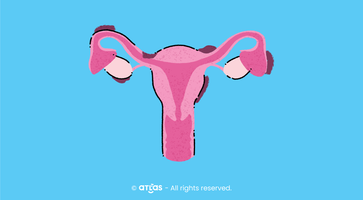 Endometrioza - află mai multe despre, cauze, simptome, tratament!
