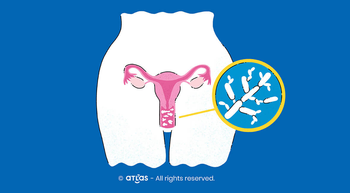Candidoza vaginală - siptome, tratament, preventie
